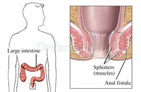 شرایط معافیت پزشکی فیستول‌ های مقعدی غیر قابل درمان