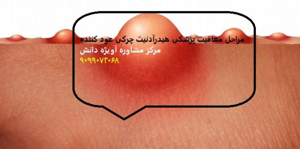 مراحل معافیت پزشکی هیدرآدنیت چرکی عود کننده3