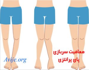 معافیت سربازی پای پرانتزی