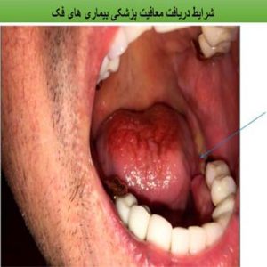 چگونه معافیت پزشکی بیماری های فک، دهان و دندان بگیریم؟