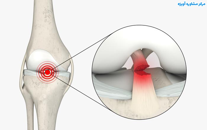 مراحل تایید بیماری جهت دریافت معافیت پزشکی پارگی رباط صلیبی چیست؟