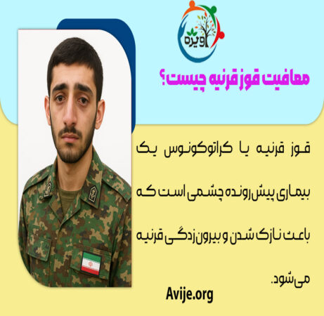 معافیت قوز قرنیه